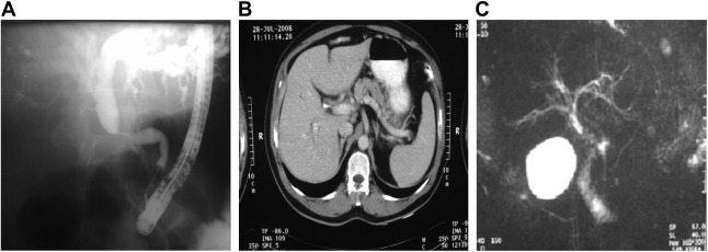 Imaging studies. (A) Endoscopic retrograde cholangiopancreatography showing the ...