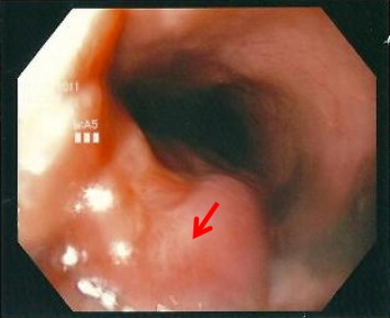 Esophagogastroduodenoscopy illustrating the nonpigmented polypoidal mass 25 cm ...