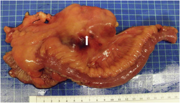A surgery with right hemicolectomy showed a 7-cm length appendiceal tumor (white ...