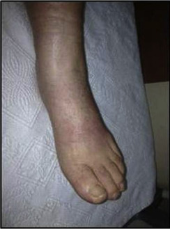 Foot and ankle of the patient at presentation.