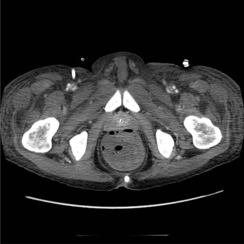 Abdominal CT scan image revealing the distended rectum with surrounding air ...