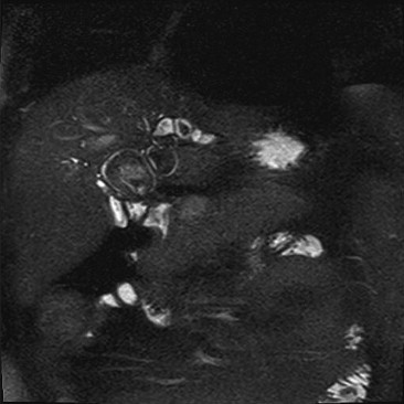 Magnetic resonance showing multiple stones in the left hepatic duct.