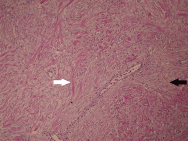 Photomicrograph of the tumor reveals a mesenchymal, spindled hypocellular ...