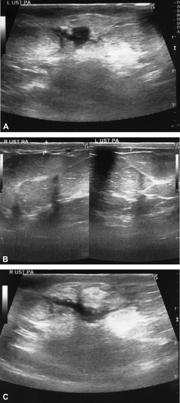 Common sonographic findings of IGM (A–C). (A) The most common finding is ...