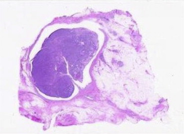 The pathological diagnosis was intraductal papilloma of the breast.