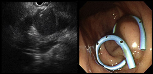 Endoscopic-ultrasound-guided puncture with 19G fine-needle aspiration biopsy ...