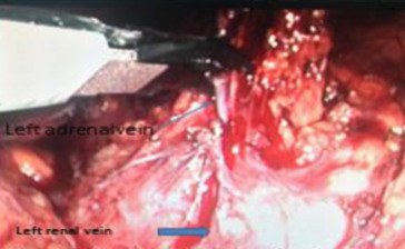 Clipping of the left adrenal vein.