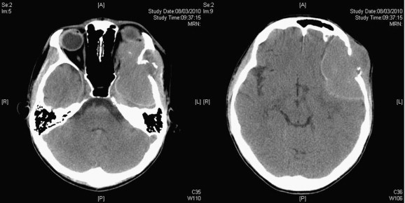 (Left) Preoperative plain computed tomography of the brain showed tumor ...