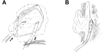 Schematic illustration showing soaked dressings in an open-window thoracostomy ...