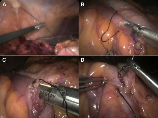 The steps of creating intracorporeal ileocolic anastomosis. (A) Suspension of ...