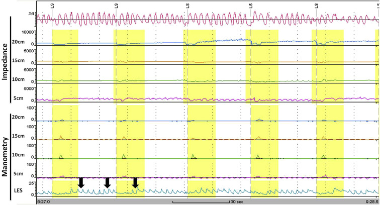 Impedance of a patient who underwent Heller myotomy showing low baseline ...