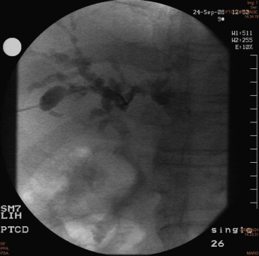 The cholangiography of initial cholangitis (September 2008) showed there was ...