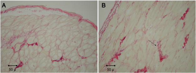 Example of Sirius Red staining from atrial tissue from patients with A. low-risk ...
