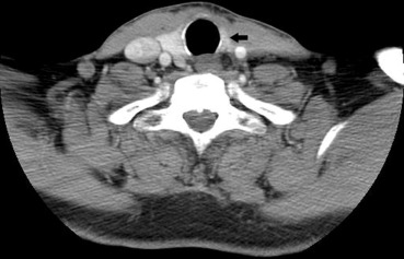 The lesion in the left thyroid lobe became smaller (black arrow) 2 years after ...