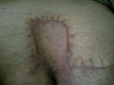 Flap is shown 1 month after the operation.