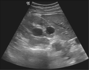 Ultrasound of patient kidney (kidney cysts).