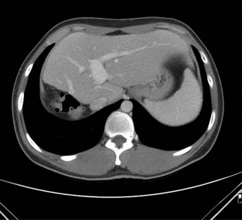 Computed tomography of the donor 5 months after surgery.