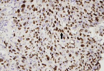 p40 immunohistochemical stain revealed tumor cells of squamous epithelial origin ...