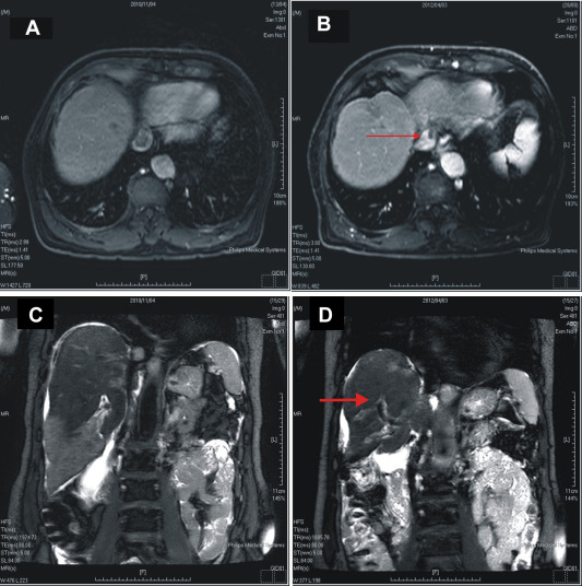 Effect of treatment with sorafenib and radiotherapy evaluated by abdominal ...