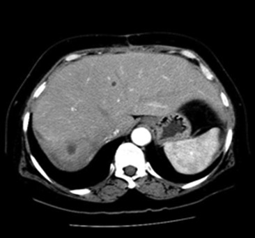Computed tomography scan after 3 months showed regression of the liver abscess ...