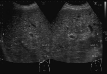 Abdominal ultrasonography showing multiple tiny hyperechoic nodules, 0.1–0.5 cm ...
