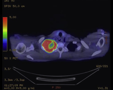 Positron emission tomography–computed tomography scan showing pancoast tumor.