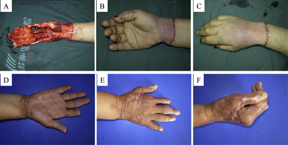 Total hand degloving injury (Case 1). (A) Before surgery. (B) Palm side ...