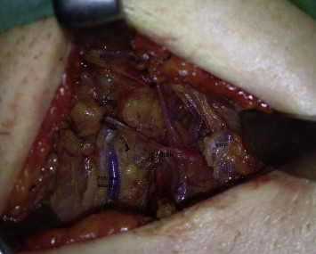 Photograph of right axillary lymph node dissection performed through a lower ...