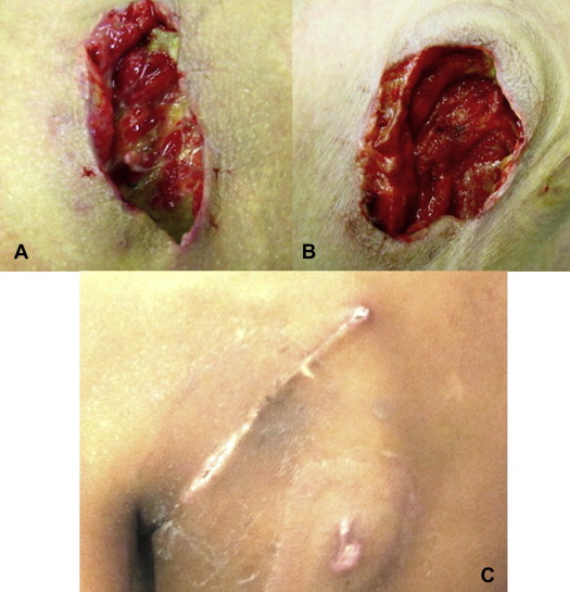 (A) Infected wound areas with deposits of fibrin and pus. (B) Same wound after ...
