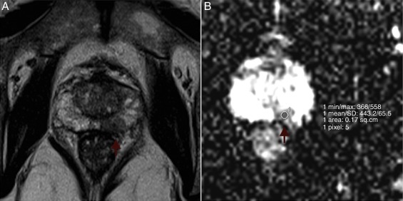 Example of ROI placement. Left peripheral prostate cancer in a 67-year-old man ...