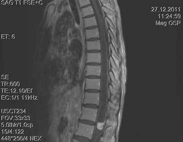 Sagittal T1-weighted magnetic resonance imaging with gadolinium contrast ...