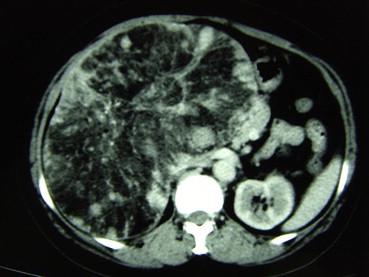 CT showing peripheral angiomyomatous component with soft-tissue alternation, a ...