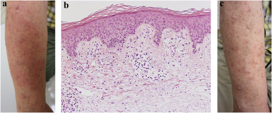 (a) Clinical findings. Pruritic erythematous plaques on the right arm. (b) ...