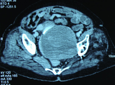 Abdominal CT. A large hypointense mass displaces the bladder and the rectum, ...
