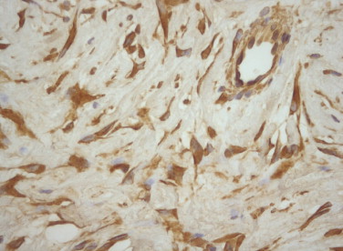 Immunohistochemical analysis showing that the neoplastic cells reacted ...