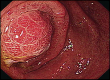 A protruding mass with edematous mucosa noted at cecum.