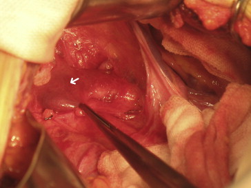 Notching from the left renal vein where compressed by the superior mesenteric ...