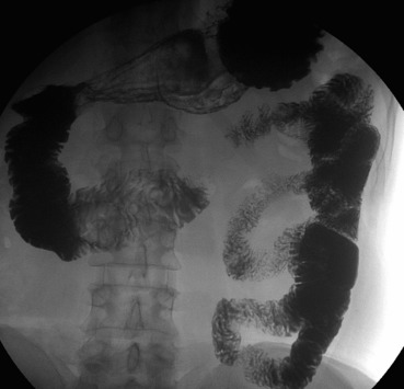 Contrast imaging of the small intestine displays the narrowing of the ascending ...
