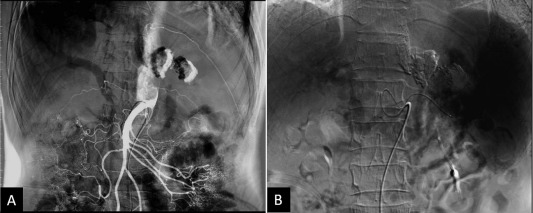 Selective abdominal angiography for characterization of portal hypertension. (A) ...