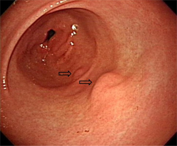 Esophagogastroduodenoscopy shows two polypoid lesions in the antrum (1.2 cm and ...