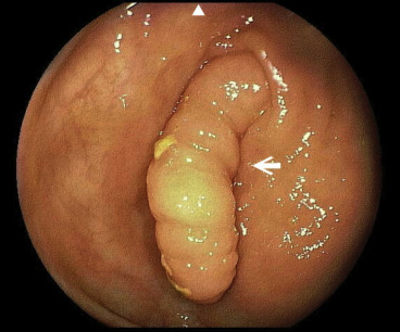 A tubular lesion measuring 0.5 cm × 5 cm within the cecum.