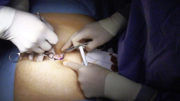 Incision in the umbilicus for the port.