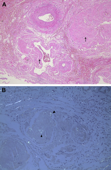 Surgical specimen: (A) amorphous pinkish hyaline deposits were observed in ...