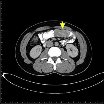 Intussusception of jejunal loops (yellow arrow).