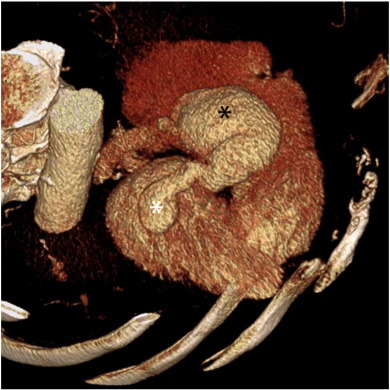 Volume rendered CT image (VRT) of the heart in right oblique projection with a ...
