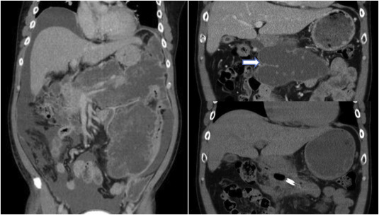 This patient had pancreatitis and extensive lobulated abscess formation in ...