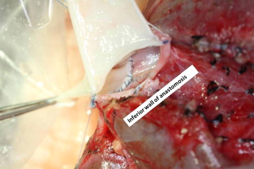 Insetting of the amyloidotic hepatic allograft hepatic venous cuff to the ...