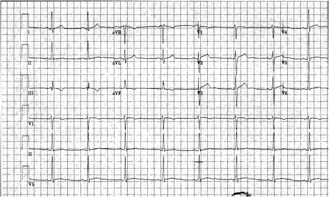 Resting ECG: Sinus rhythm with ventricular rate of 55bpm, PR interval 152ms, QRS ...