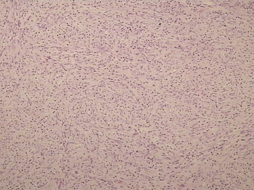 Photomicrograph demonstrating an admixture of spindle-shaped and ovoid cells ...