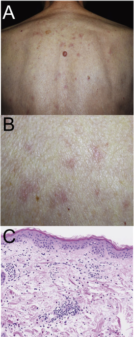 Clinical manifestation and histology.(A, B) Clinical manifestation. (A) Low ...